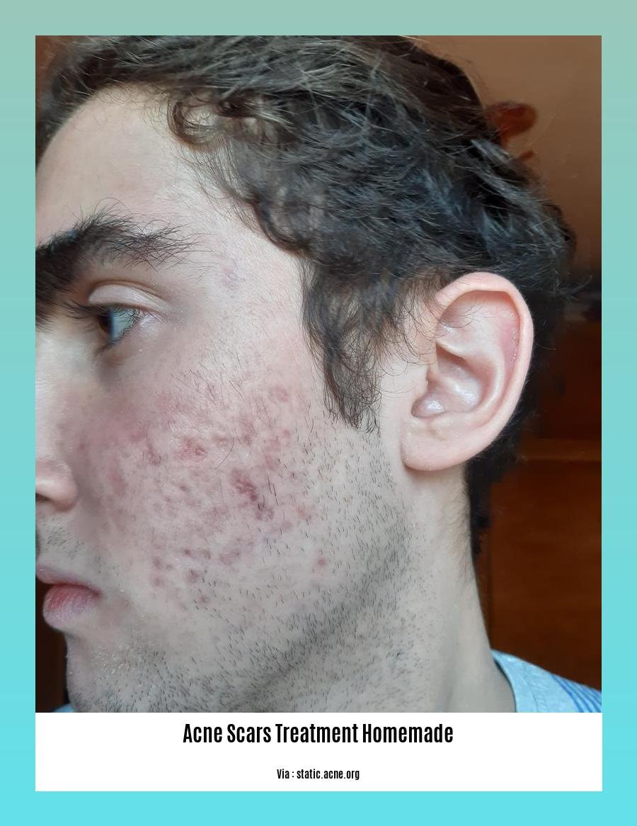 acne scars treatment homemade