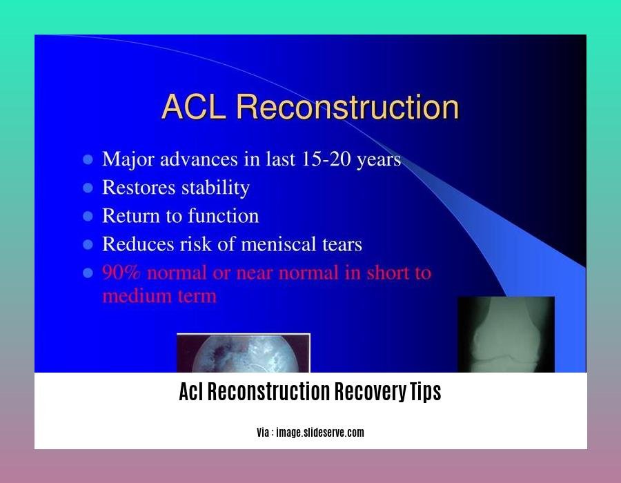 acl reconstruction recovery tips