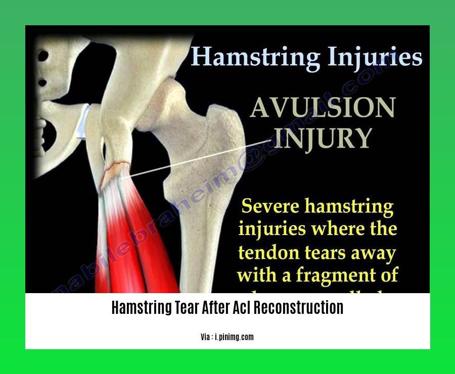 hamstring tear after acl reconstruction