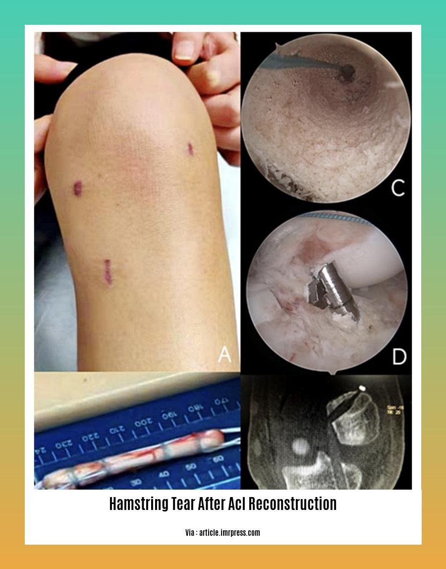 hamstring tear after acl reconstruction