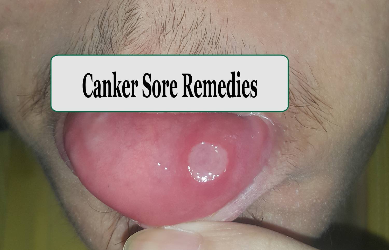 best home remedies for canker sores
