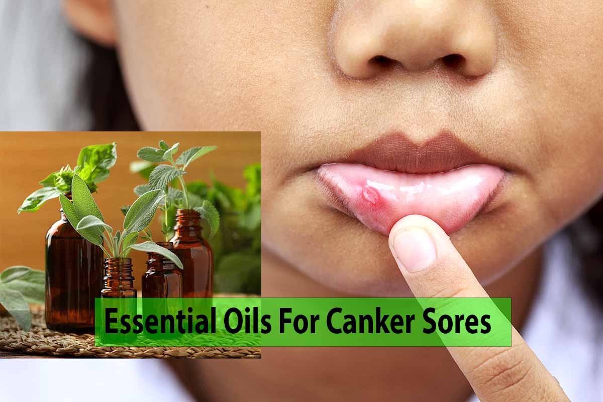 best home remedies for canker sores