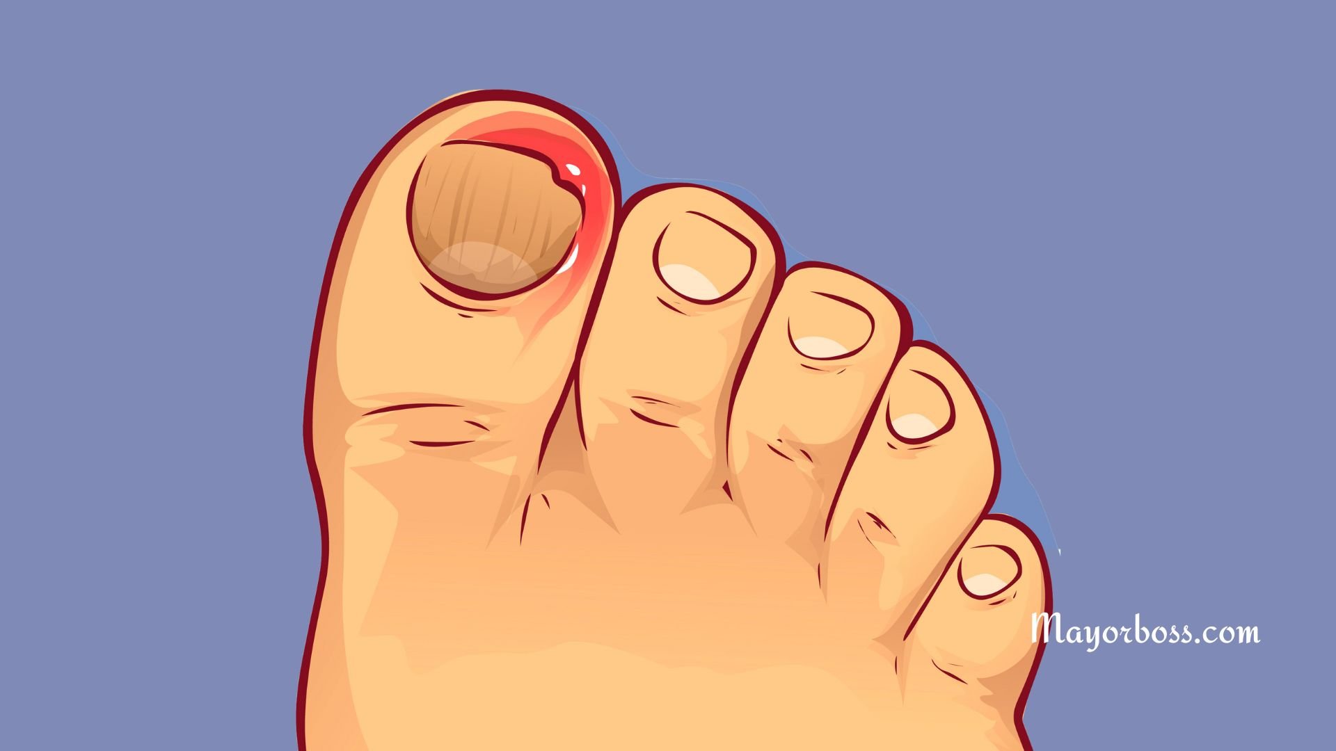 best home remedies for ingrown toenail