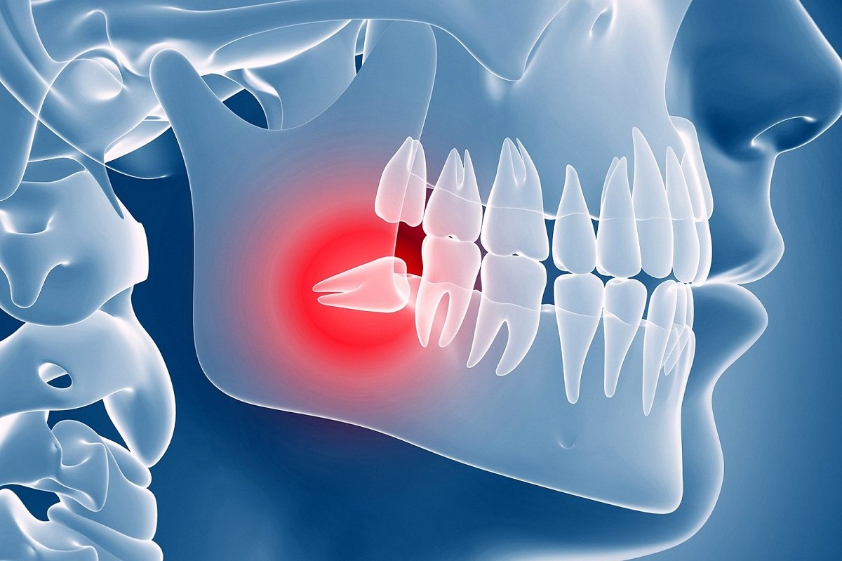 best home remedy for wisdom tooth pain