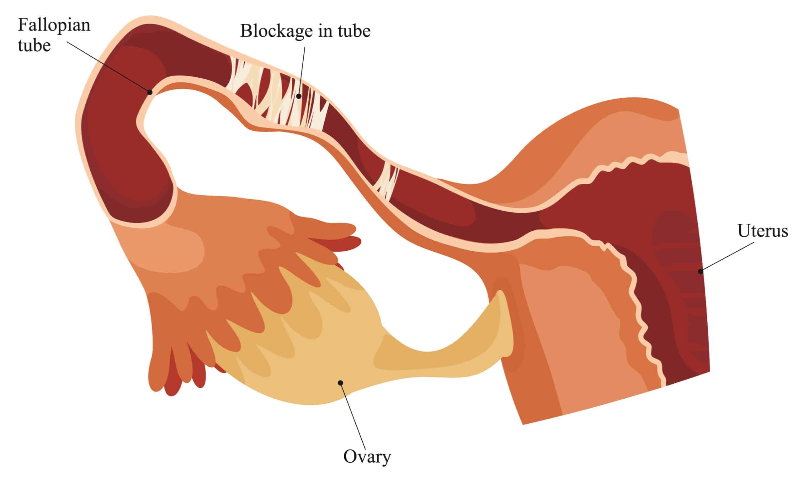 home remedies for blocked fallopian tubes