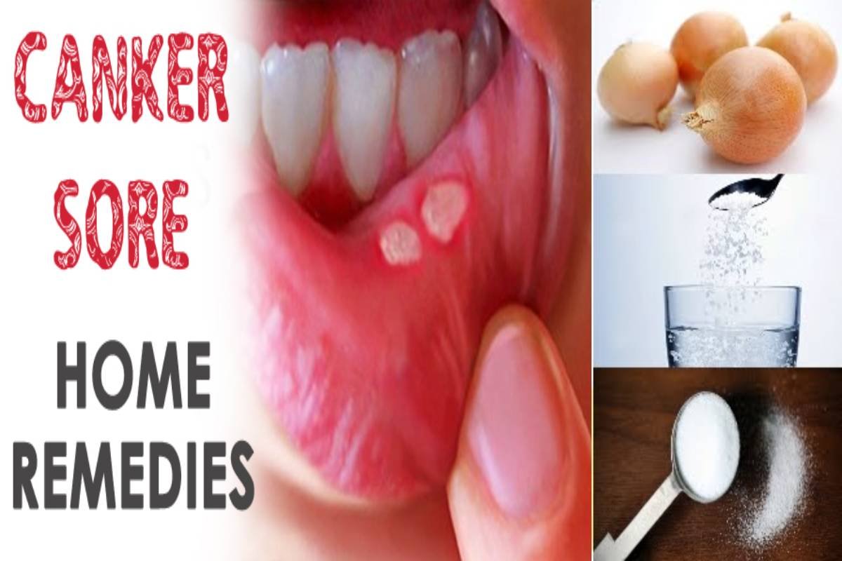 home remedies for canker sore on gums