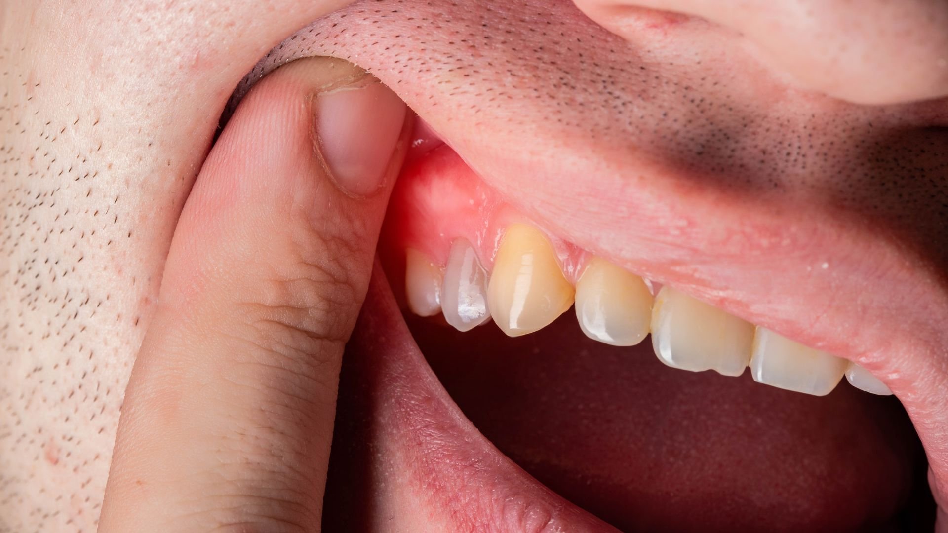 home remedies for sore gums from dentures