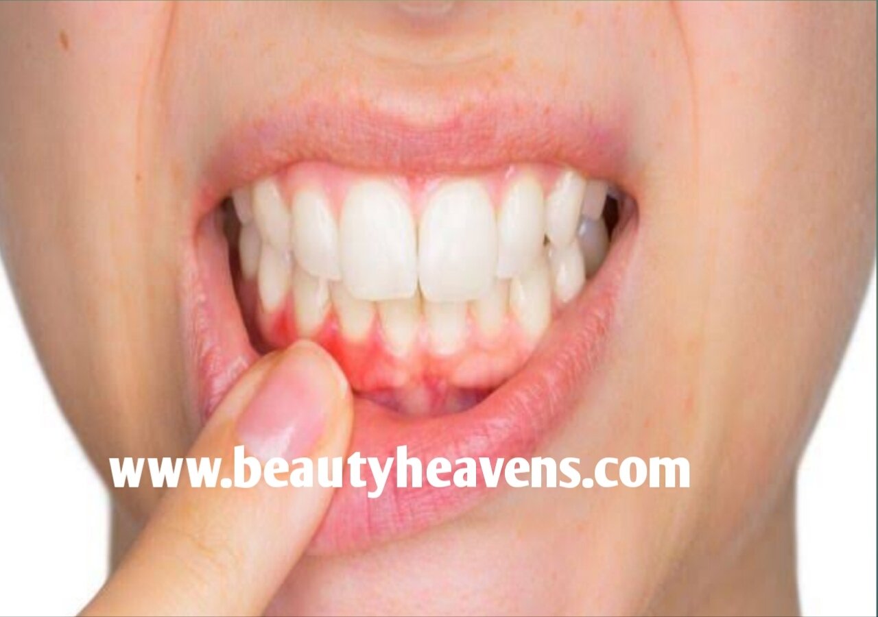 home remedies to stop bleeding gums